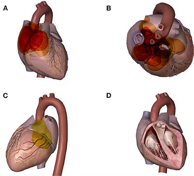 Diagnosis and Outcome of Cardiac Paragangliomas: A Retrospective Observational Cohort Study in China